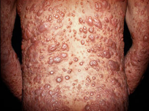 Efectos da lepra nun enfermo